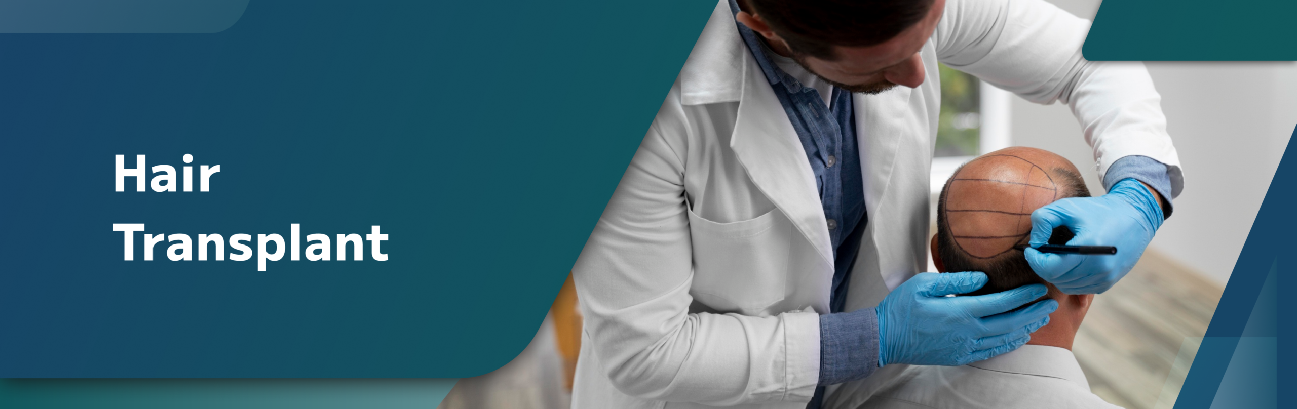 Hair Transplant in Janakpuri