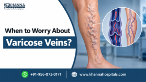 When to Worry About Varicose Veins?