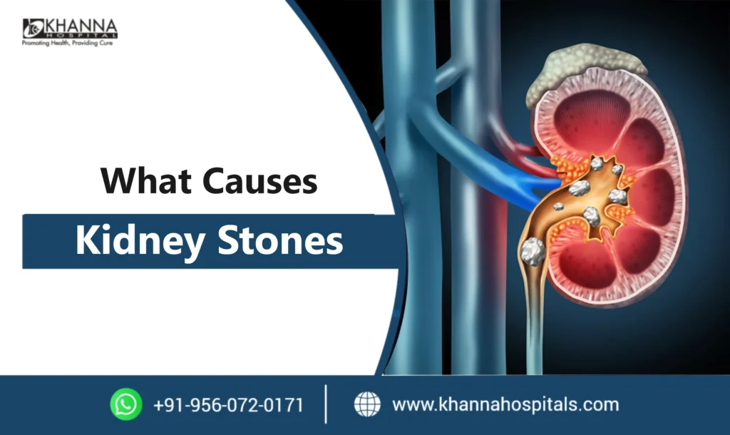 What Causes Kidney Stones