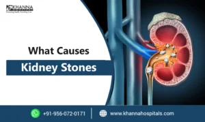 What Causes Kidney Stones? Common Causes, Risk & Prevention
